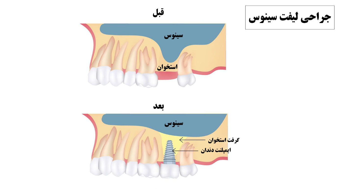 جراحی لیفت سینوس