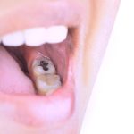 آیا آمالگام برای سلامتی مضر است؟