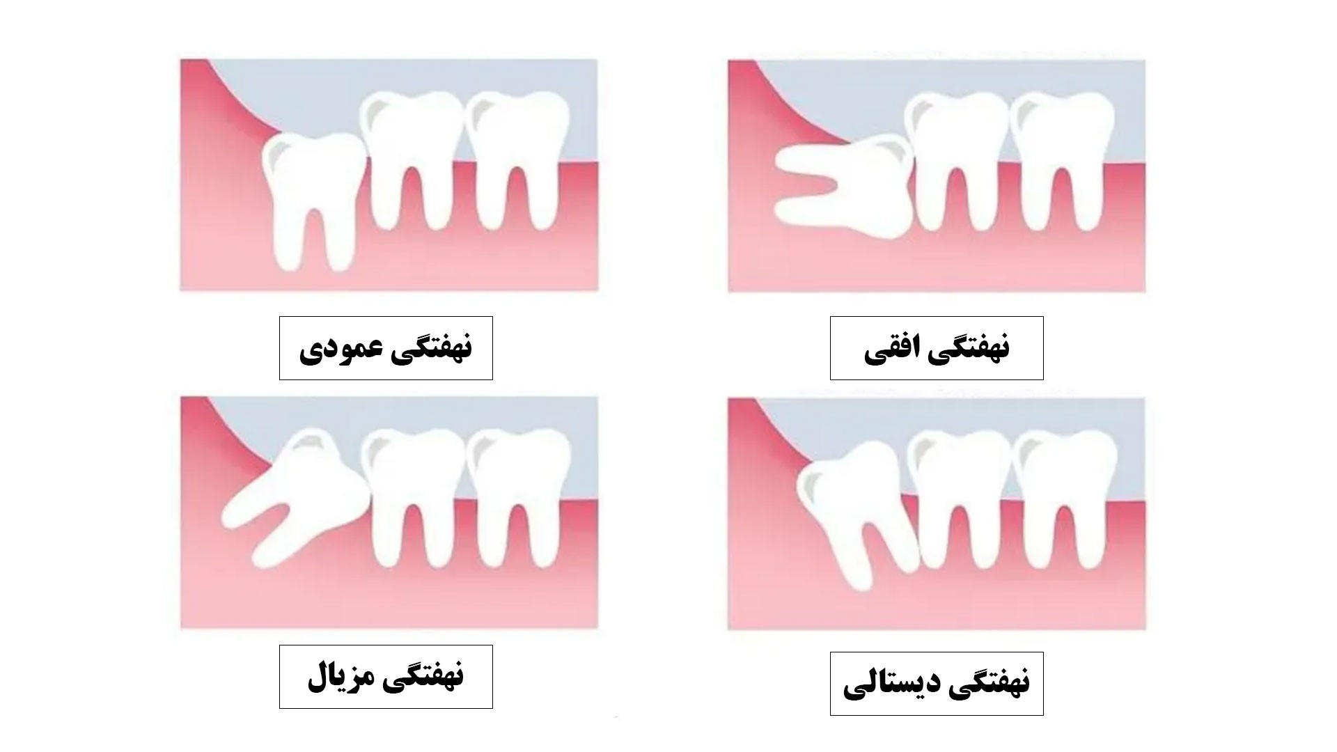 انواع نهفتگی دندان