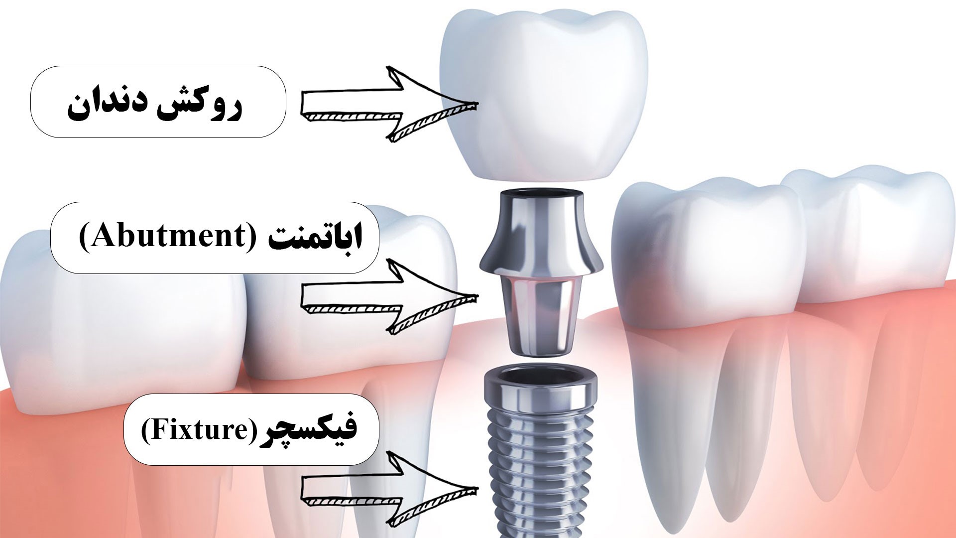 فیکسچر، اباتمنت و روکش