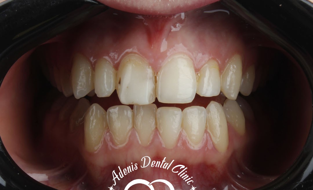 عکس قبل لمینت