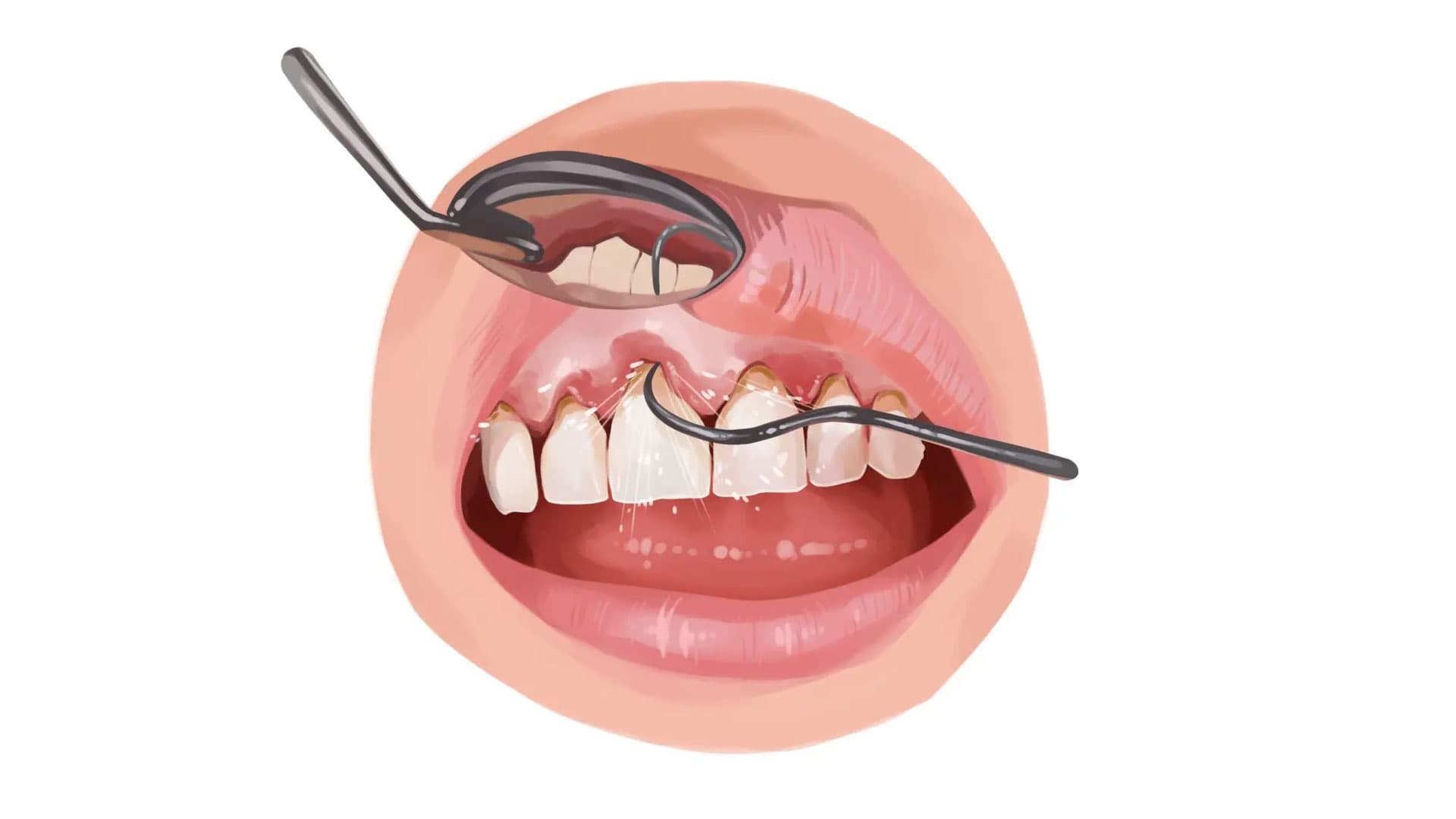 ابزار کورت برای جرم گیری