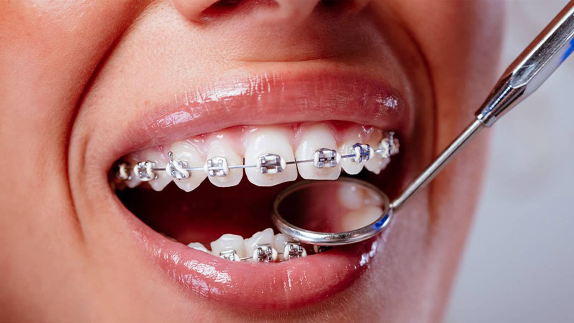 ارتودنسی دندان