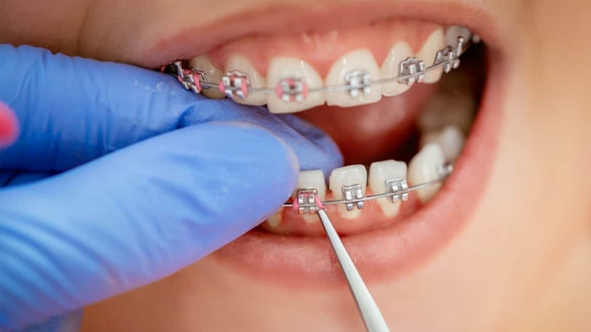 ارتودنسی یا کامپوزیت؟