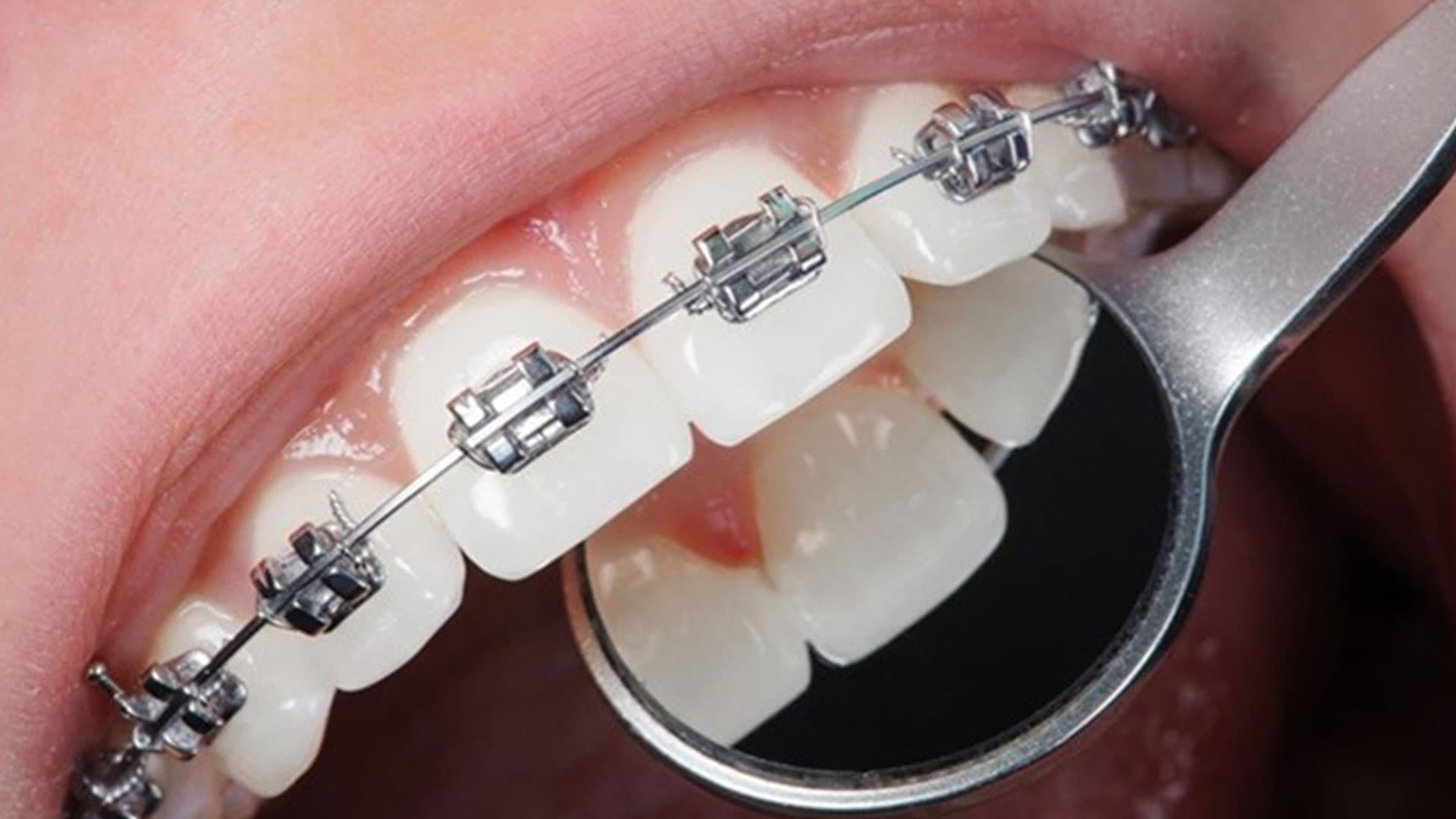 براکت دندون