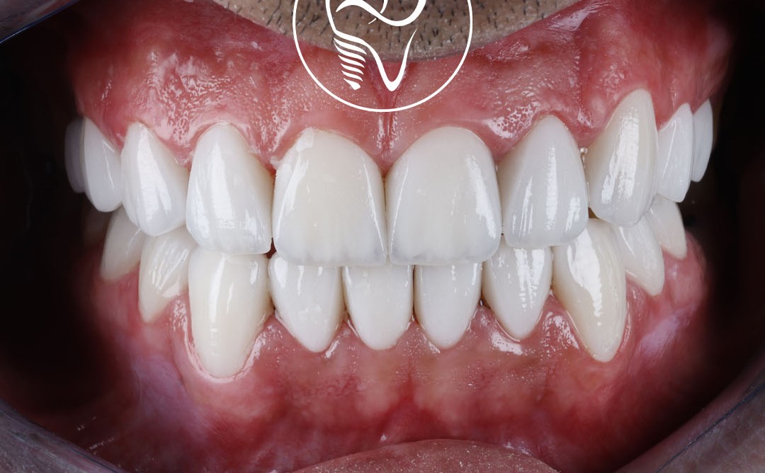 عکس بعد از لمینت