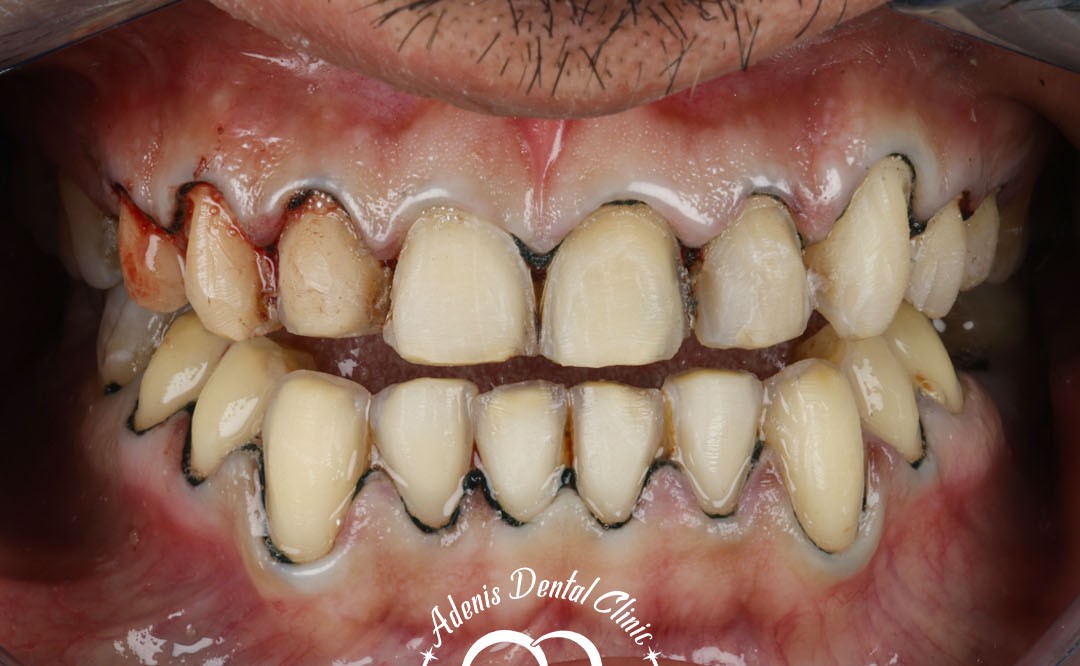 عکس قبل لمینت