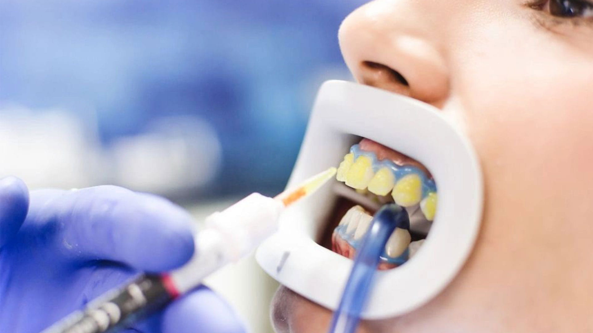 بلیچینگ دندان چیست؟