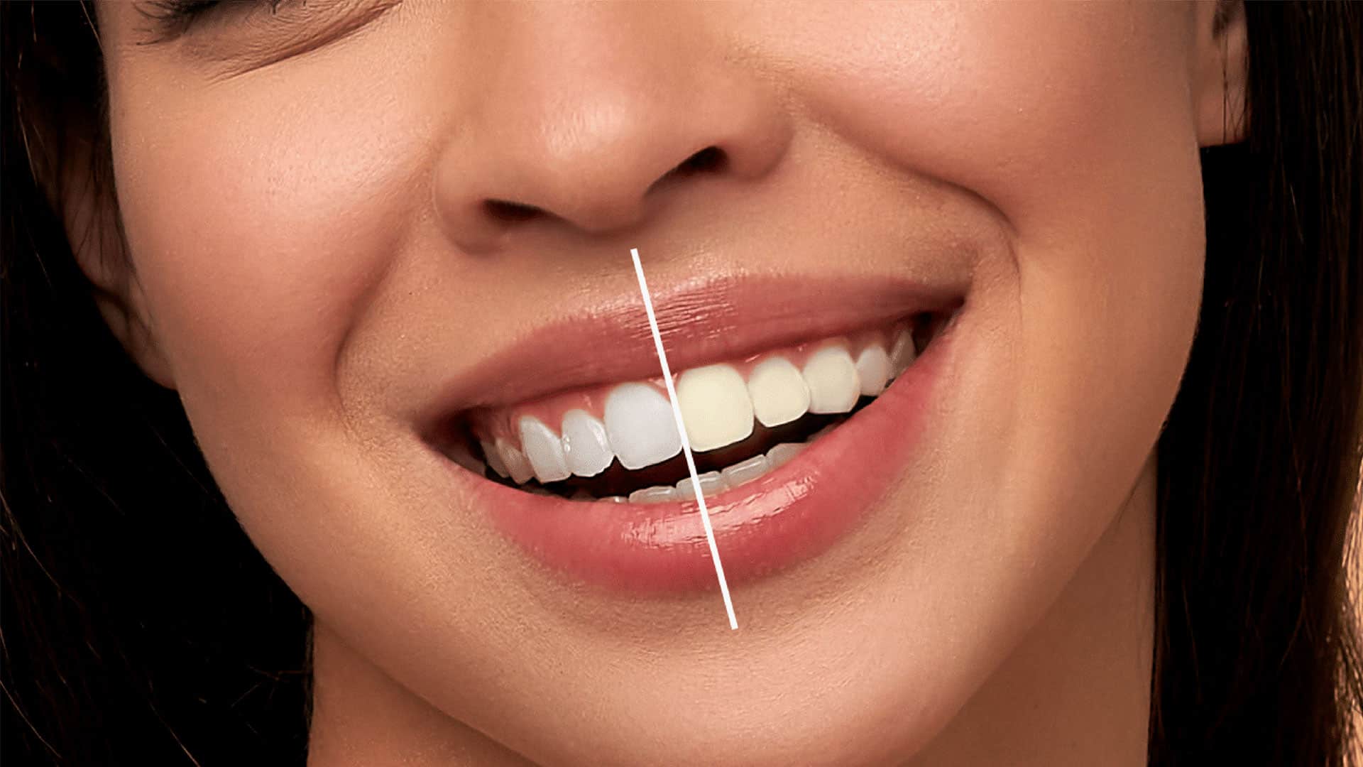 بلیچینگ دندان