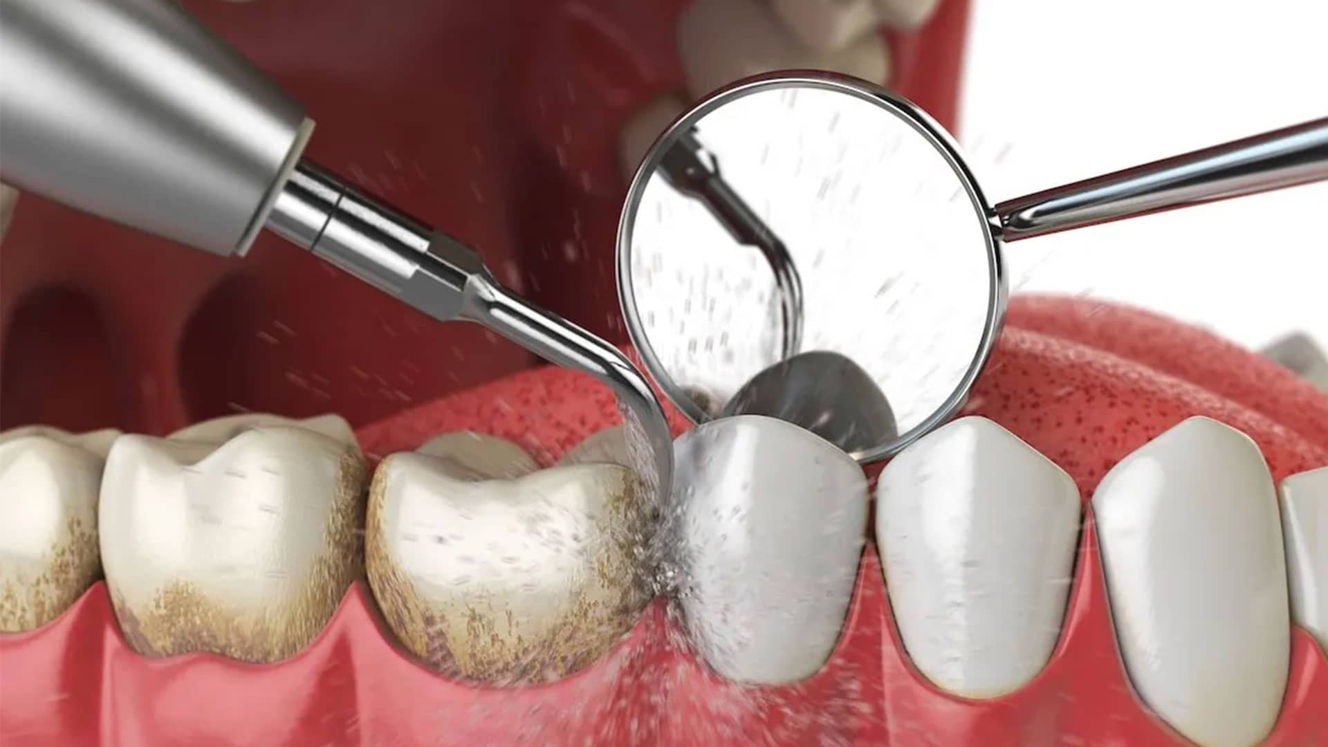 جرم گیری با روش اولتراسونیک