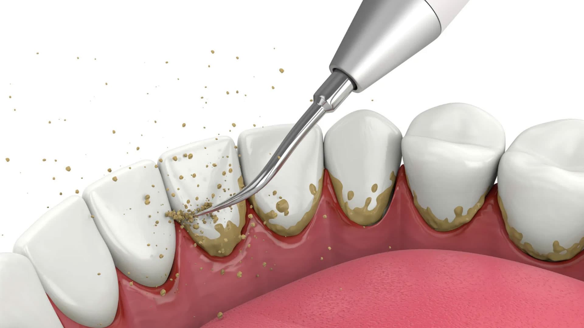 جرم گیری دندان چیست؟