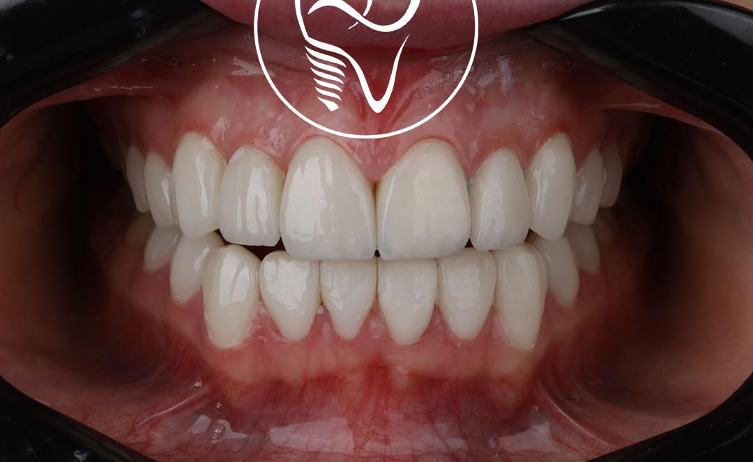 عکس بعد لمینت