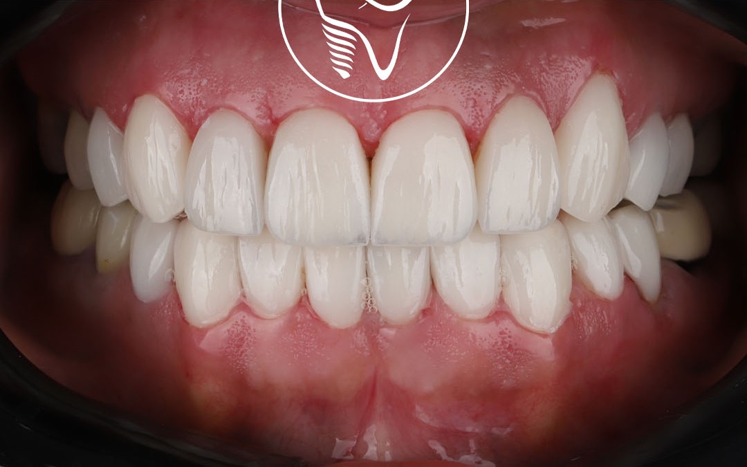 عکس بعد از لمینت