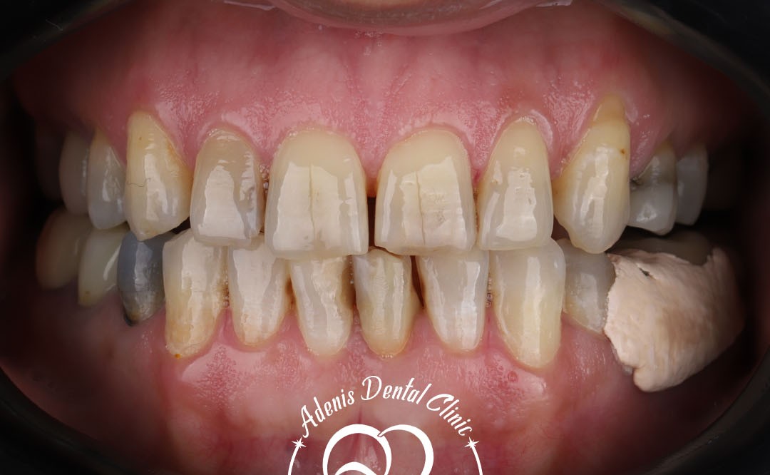 عکس قبل از لمینت