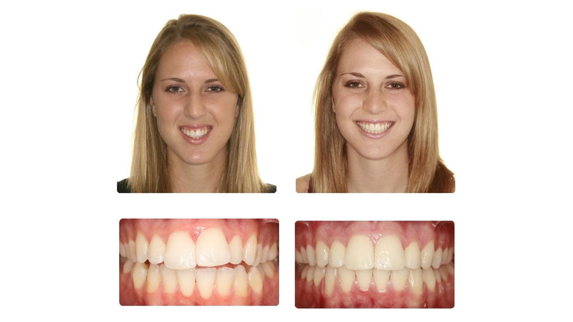 عکس قبل و بعد ارتودنسی