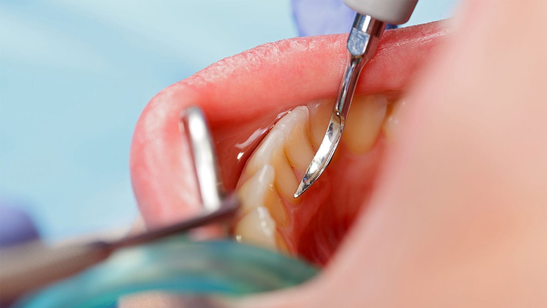 فواید جرم گیری دندان