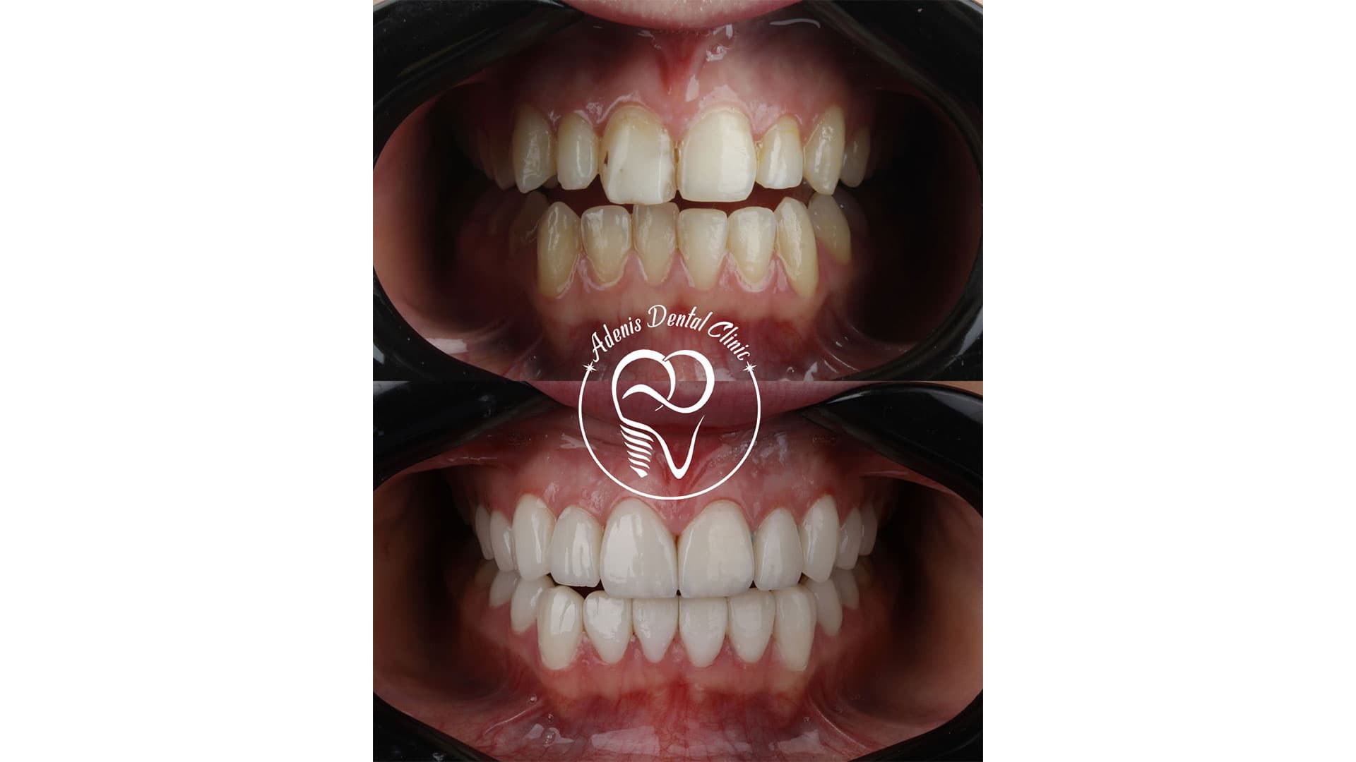 قبل و بعد لمینت دندان