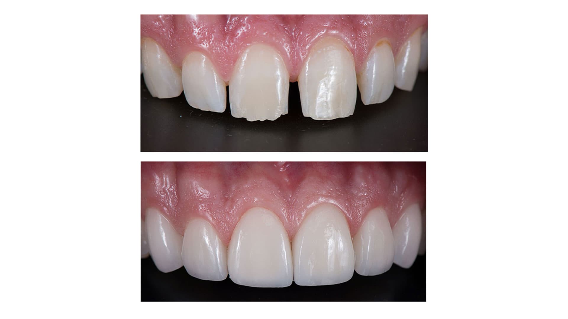 قبل و بعد کامپوزیت