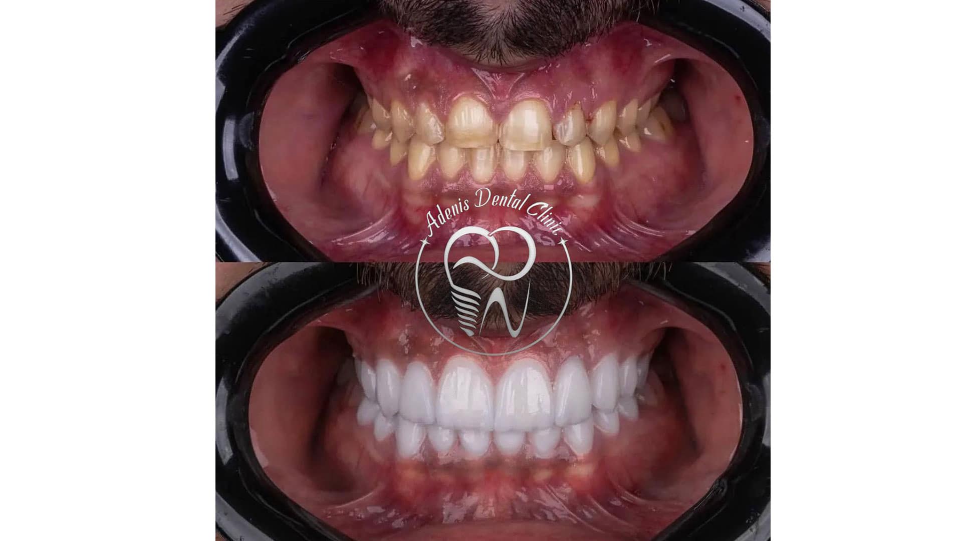 قبل و بعد لمینت دندان