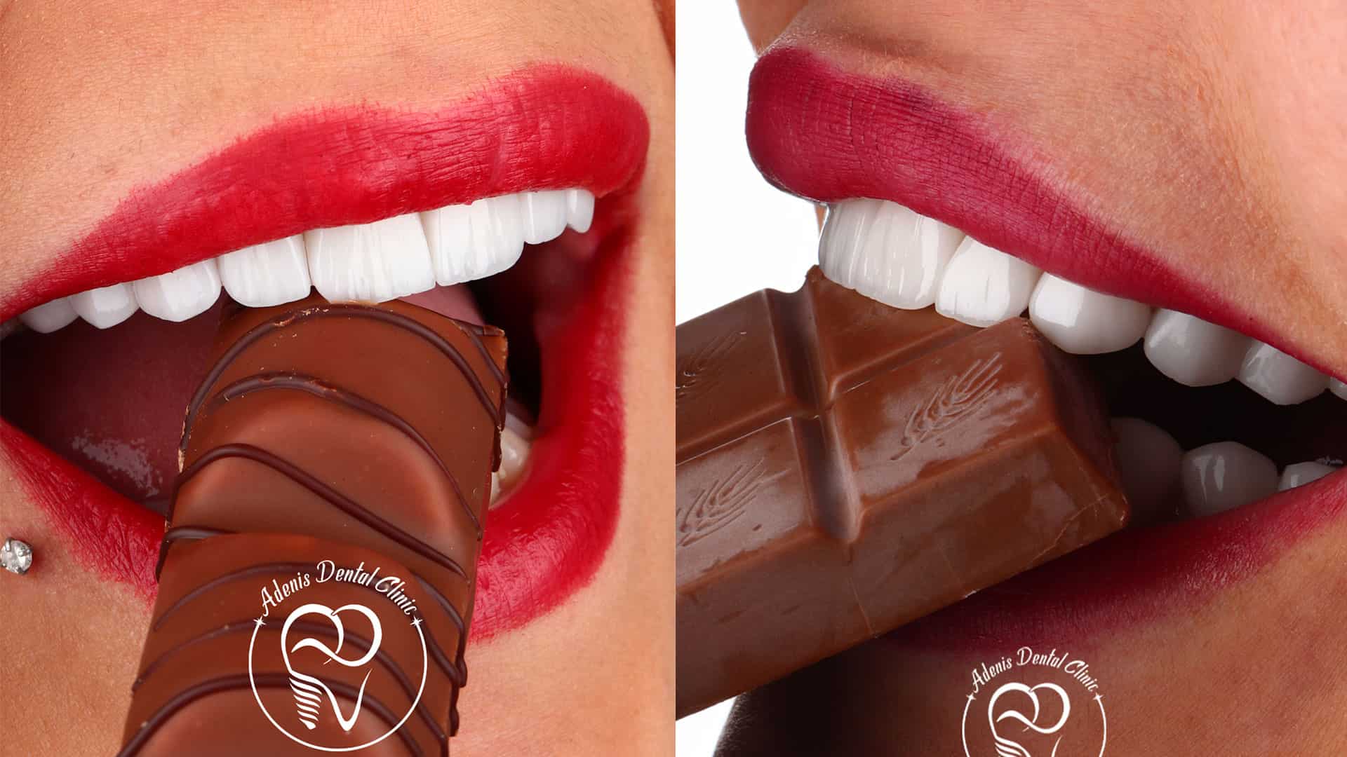 لمینت دندان