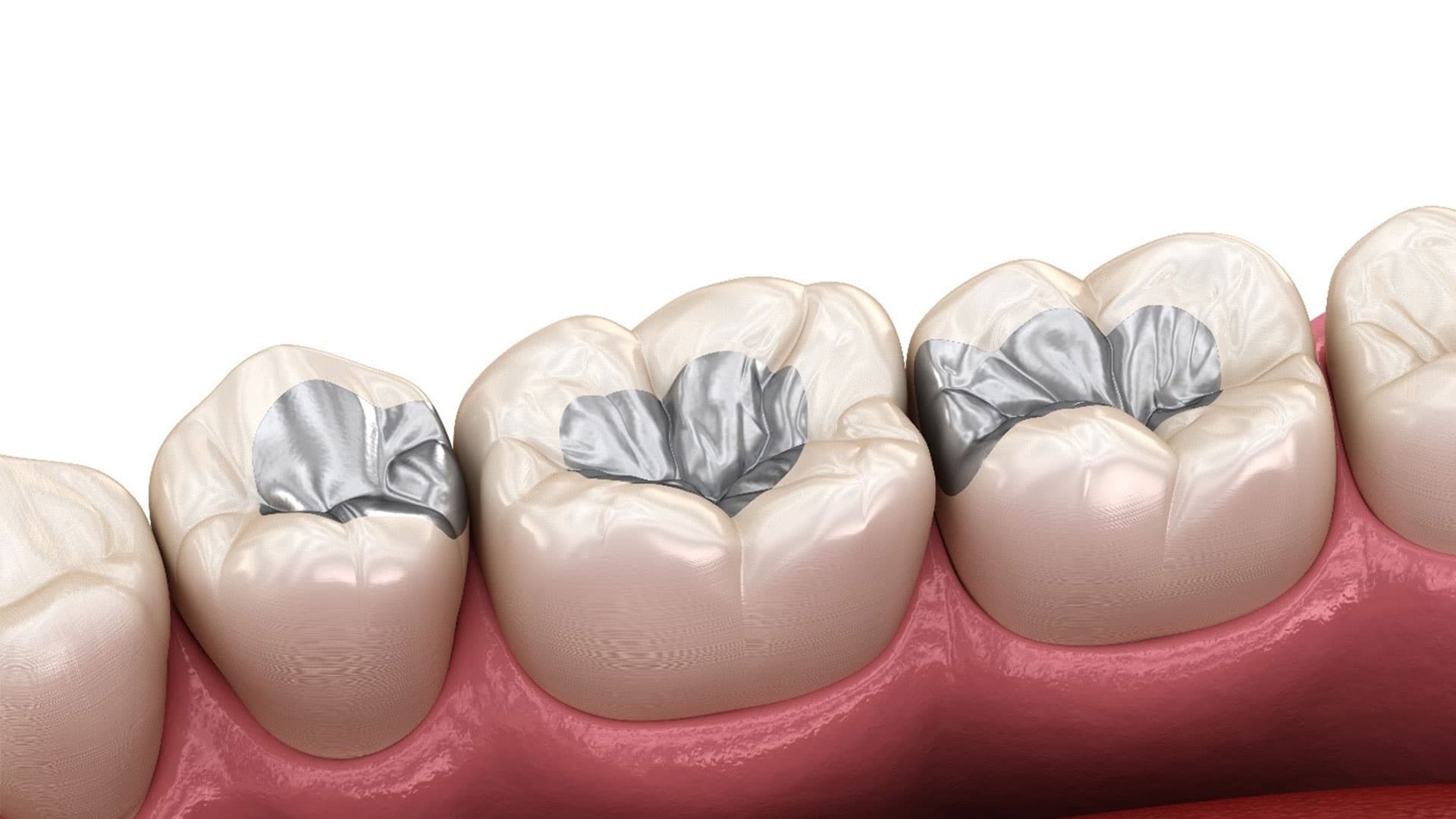 آمالگام نقره