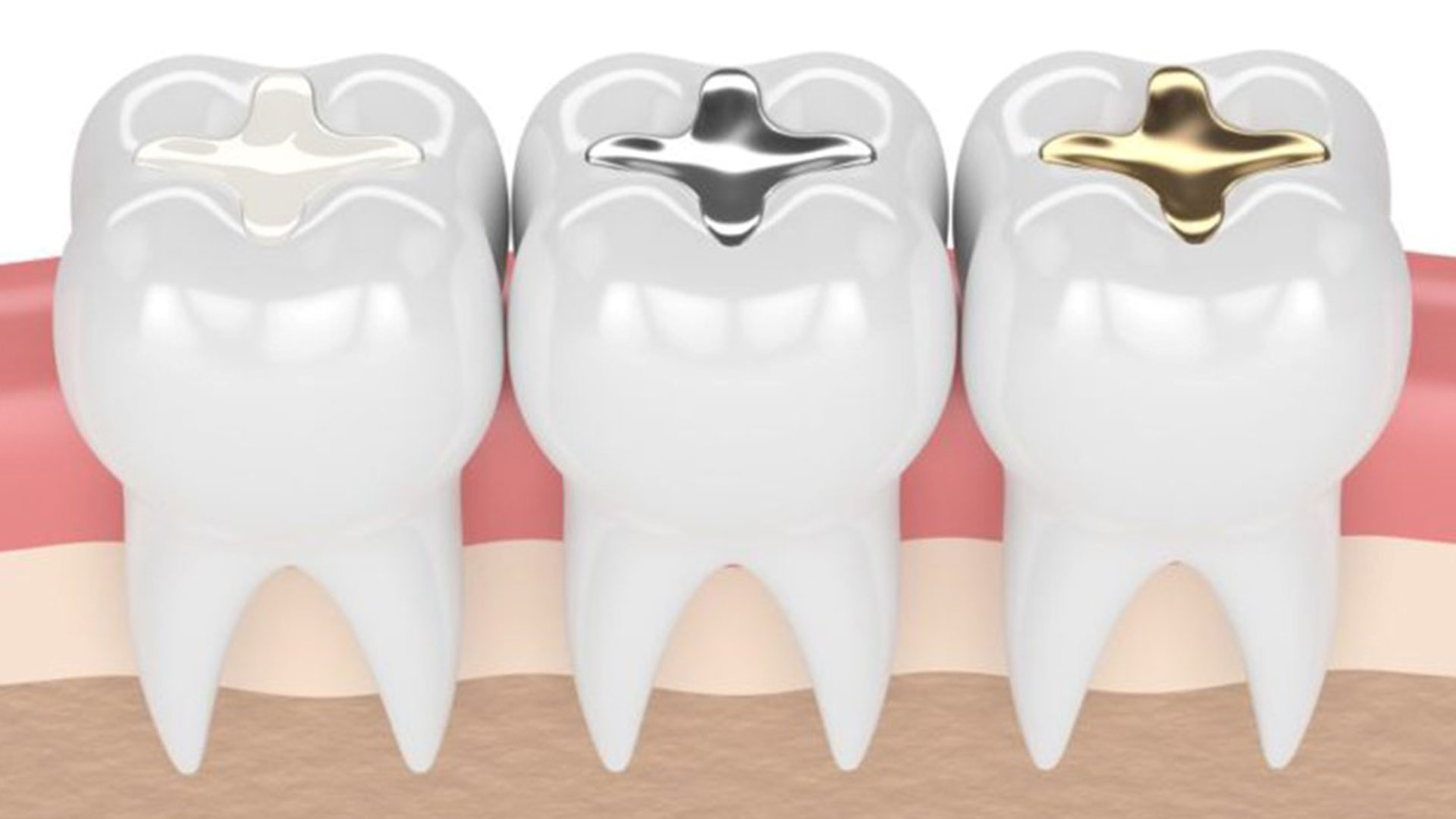انواع مواد پرکننده دندان