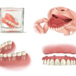 ایمپلنت یا دندان مصنوعی؟ (بررسی کامل تفاوتها)