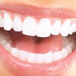 بهترین روش سفید کردن دندان (مقایسه لمینت، کامپوزیت و بلیچینگ)