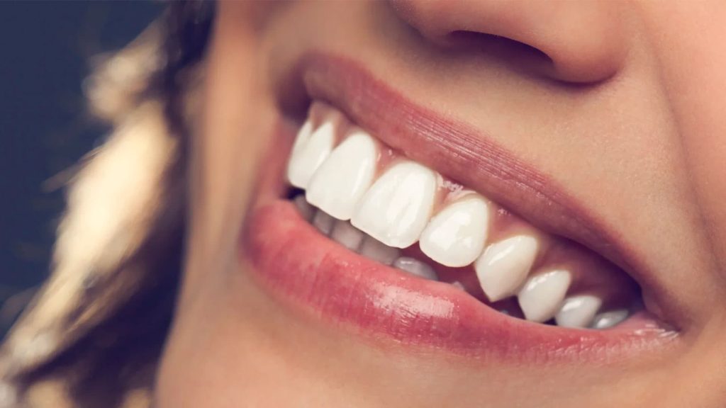 سفید کردن دندان