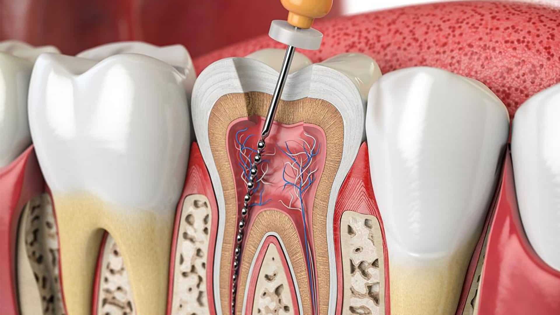 روت کانال دندان