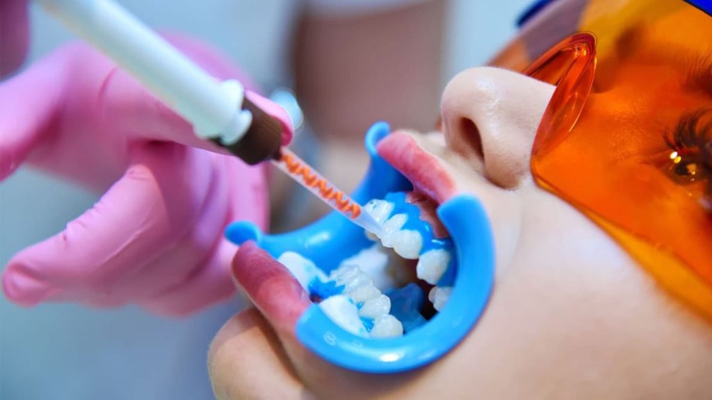 سفید کردن دندان با بلیچینگ