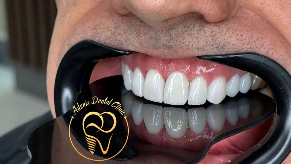 لمینت دندان در کلینیک آدنیس