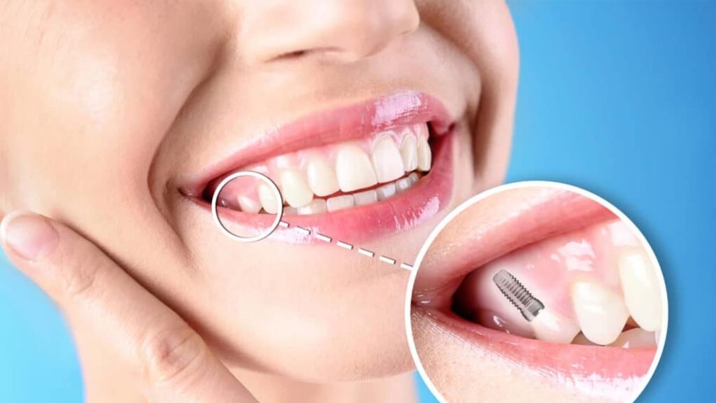 ظاهر طبیعی ایمپلنت