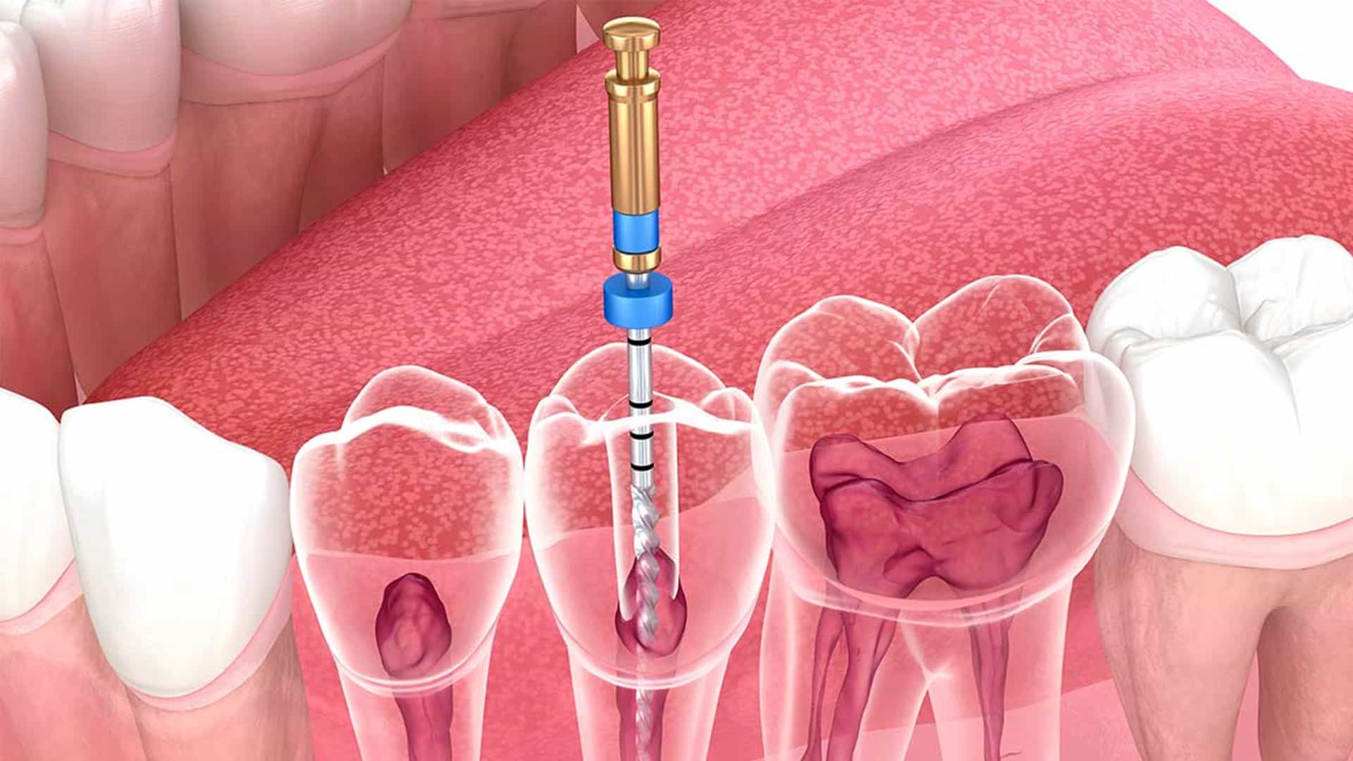 عصب کشی دندان