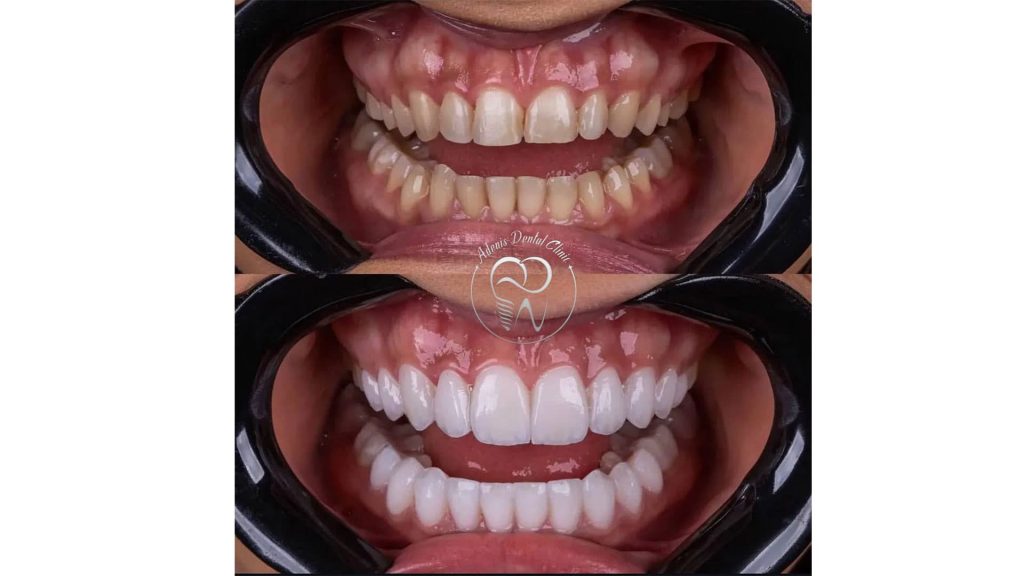 قبل و بعد لمینت دندان در کلینیک آدنیس