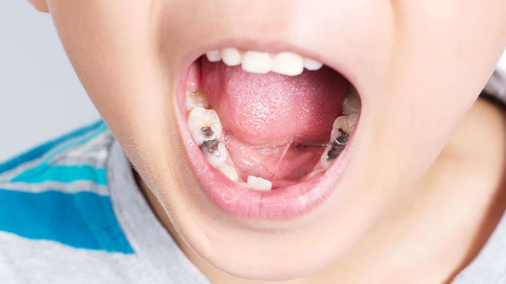 پر کردن دندان با امالگام