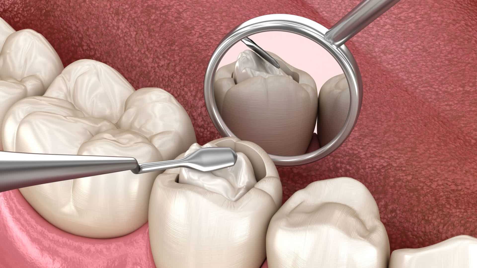 پر کردن دندان با کامپوزیت