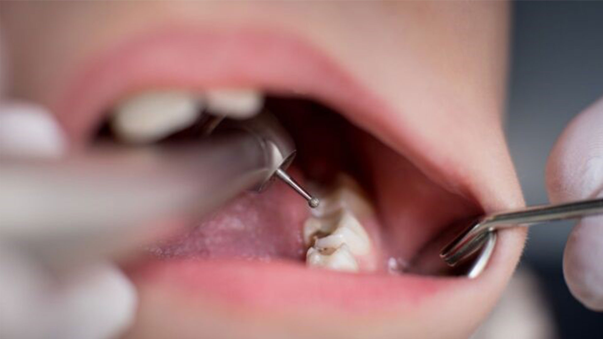 پر کردن دندان