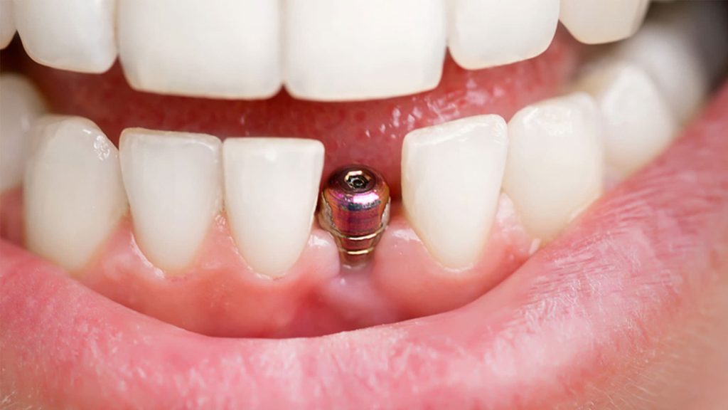 کاشت پایه ایمپلنت