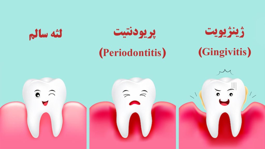 بیماریهای لثه