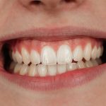 سلامت لثه: چگونه از بیماریهای لثه پیشگیری کنیم؟