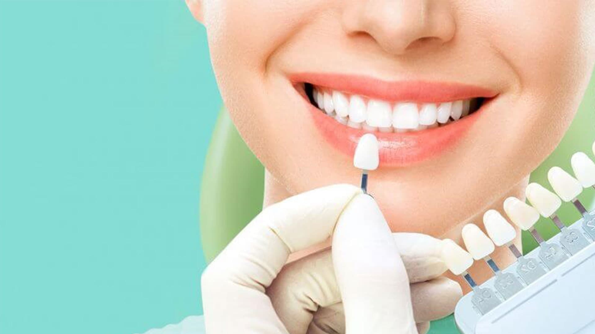 لمینت دندان