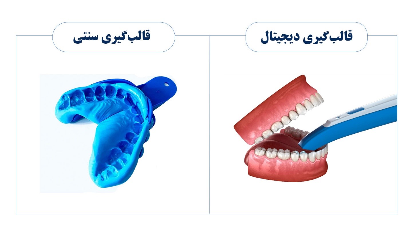تفاوت قالب گیری دیجیتال و سنتی
