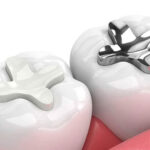 پر کردن دندان با آمالگام یا کامپوزیت: کدام بهتر است؟