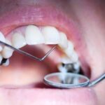 پوسیدگی زیر روکش دندان چگونه درمان میشود؟