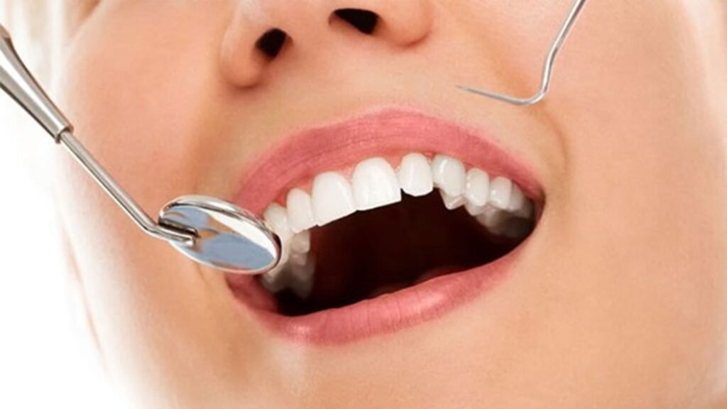 دندانهای سفید و زیبا