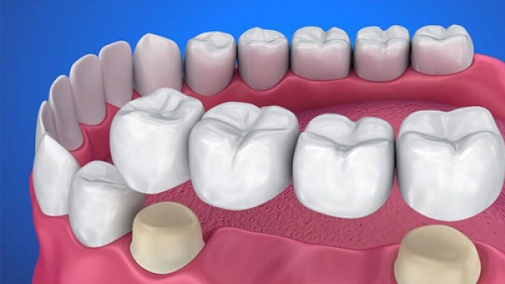 بریج بهتر است یا ایمپلنت؟