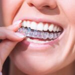 ارتودنسی نامرئی (اینویزیلاین) برای چه کسانی مناسب است؟