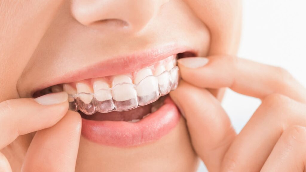 اینویزیلاین چیست؟