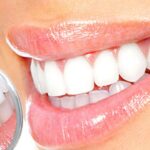 ماندگاری لمینت دندان چقدر است و چه عواملی آن را کاهش میدهد؟